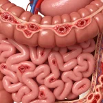 obat radang usus